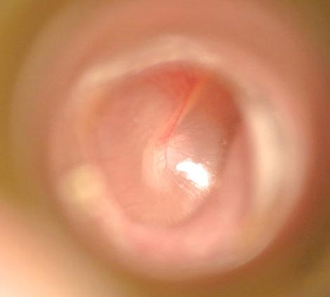 中耳炎：ごく初期の所見です。耳の違和感を感じる時です。