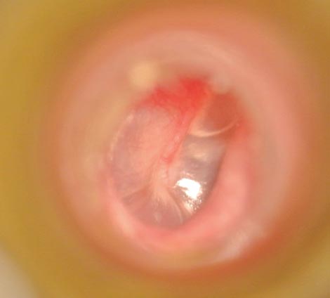中耳炎回復期：貯留液があり耳がこもった感じが続いています。