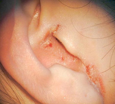 外耳道耳介湿疹１